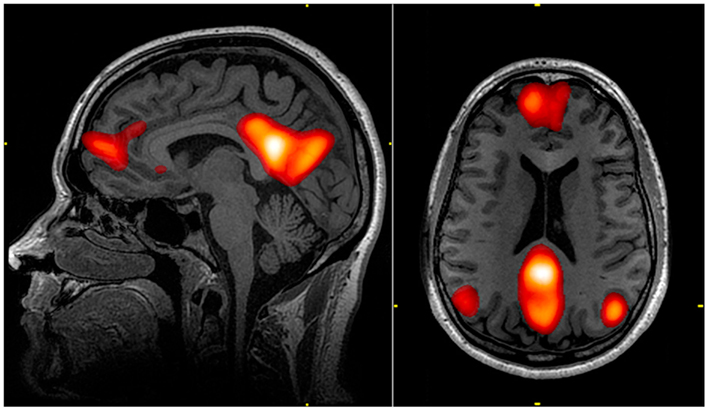 Default mode network WRNMMC